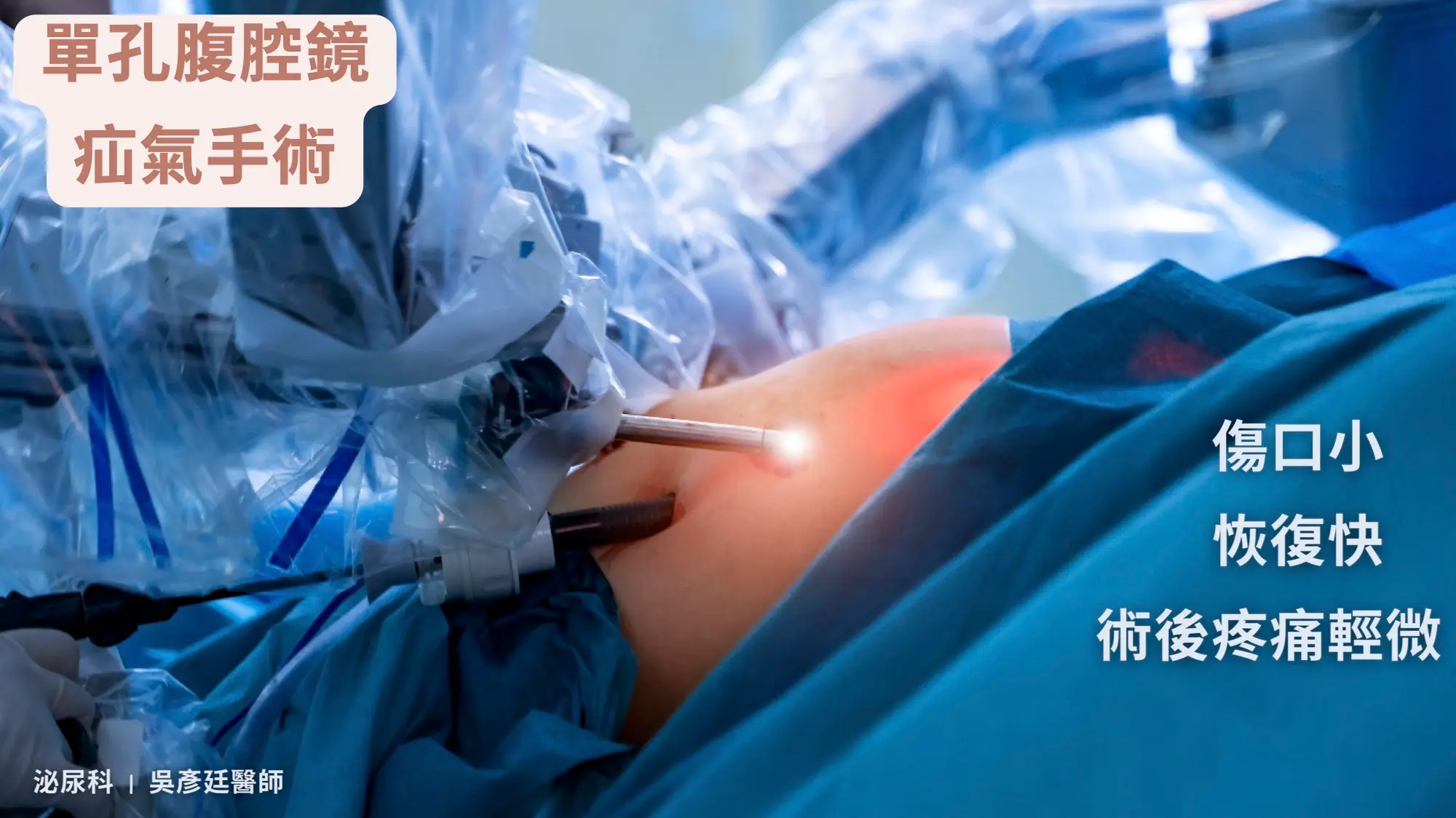 腹股溝疝氣的手術治療：單孔腹腔鏡