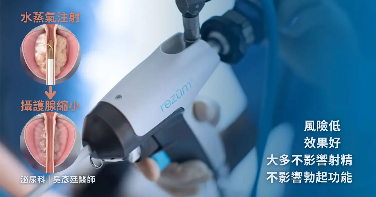 攝護腺肥大微創治療新技術：水蒸氣消融手術