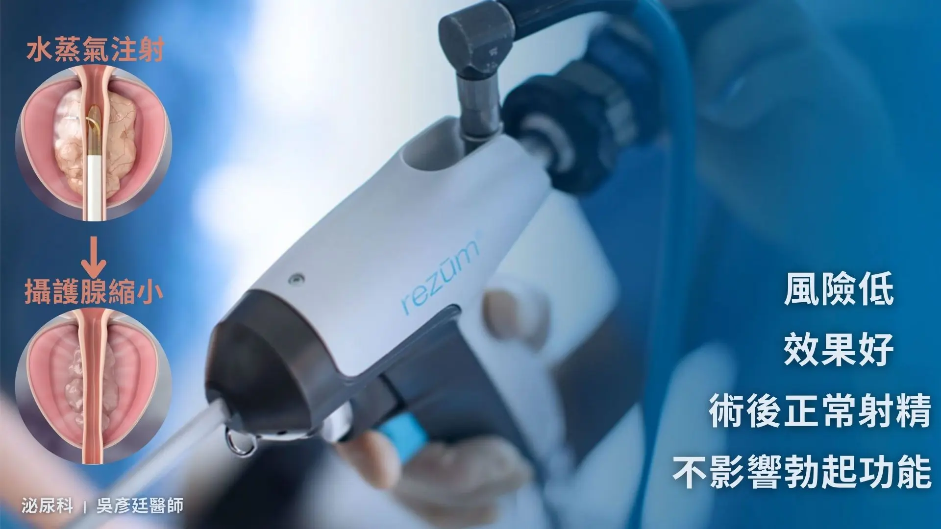 攝護腺肥大微創治療新技術：水蒸氣消融手術